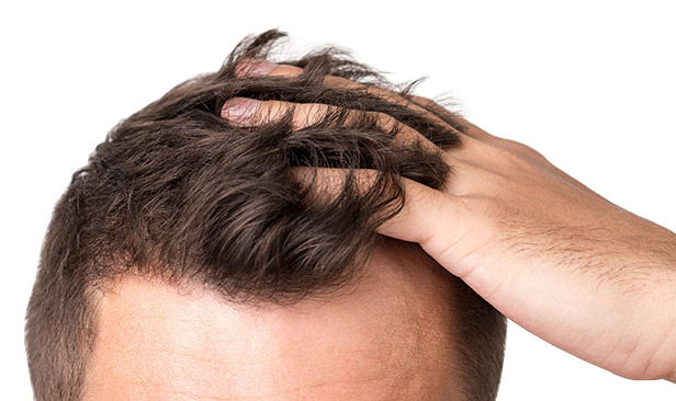 PRP Hair Regrowth Lubbock